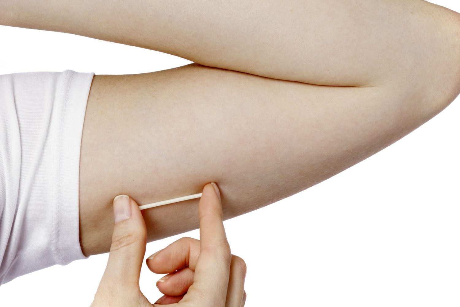 NEXPLANON® (etonogestrel implant)