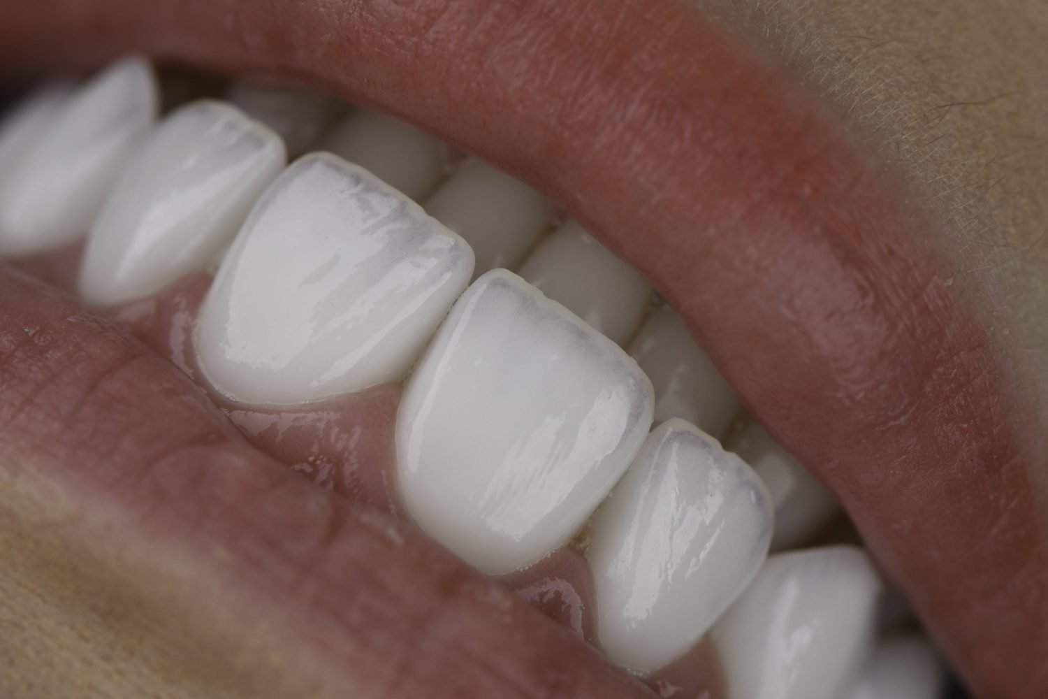 Lentes de Contato dental- feitas pelo Dr Paulo Antonioli (1)