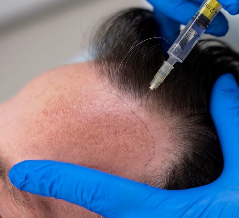 A culpa é da testosterona: calvície está ligada aos hormônios e faz o cabelo desaparecer progressivamente 1 calvície