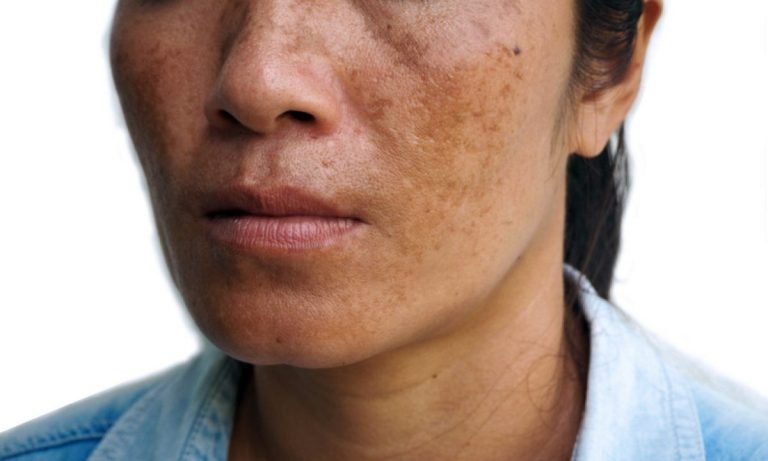 melasma-imagem-1200x720