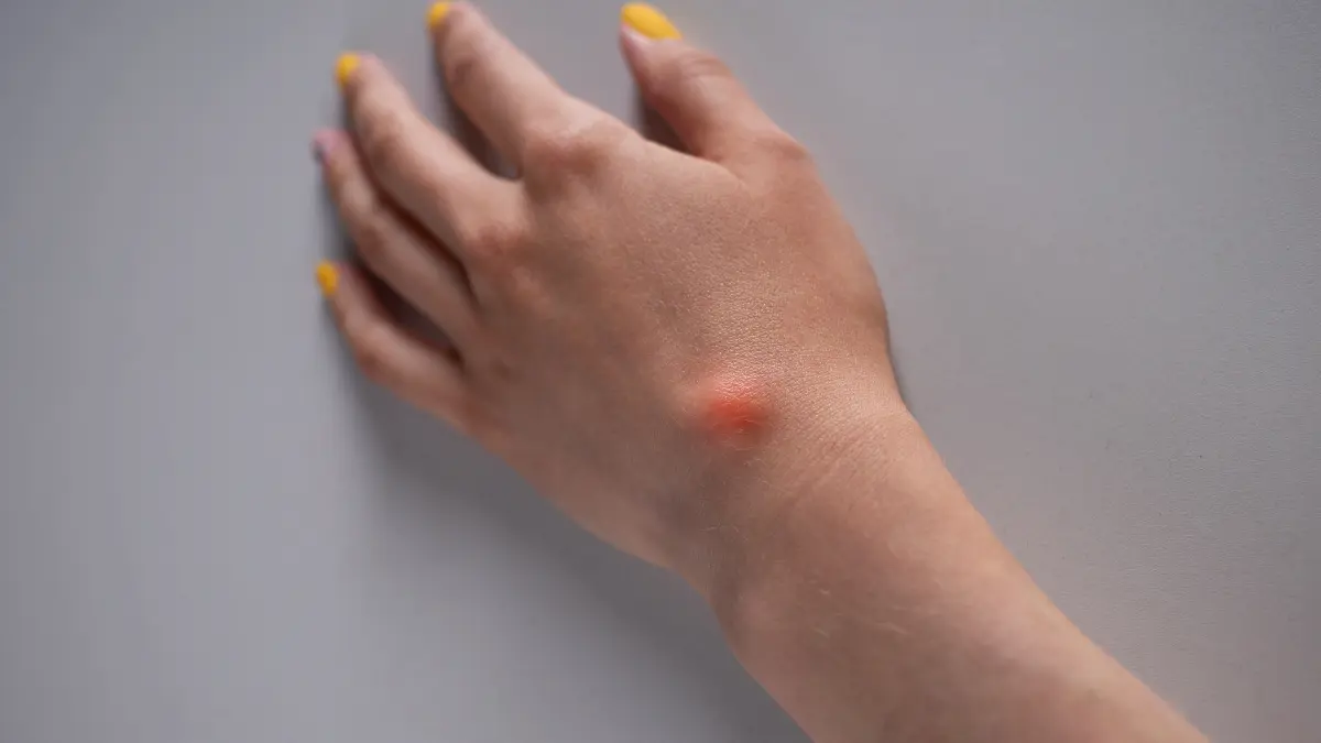 Como fazer o cisto sinovial sumir